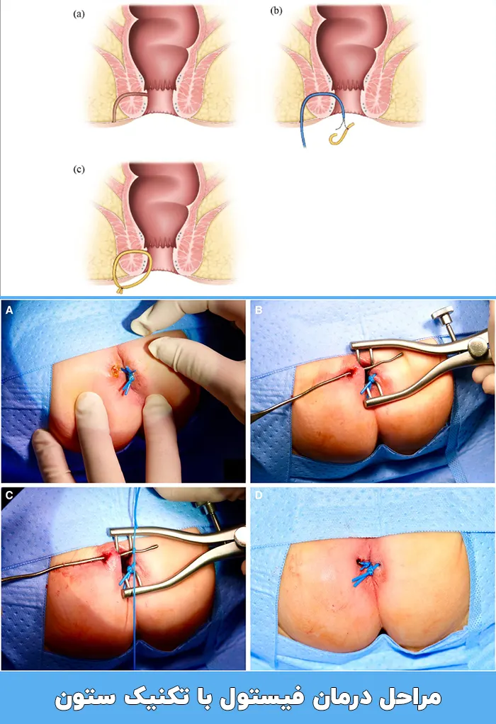 مراحل درمان فیستول مقعدی به کمک تکنیک ستون