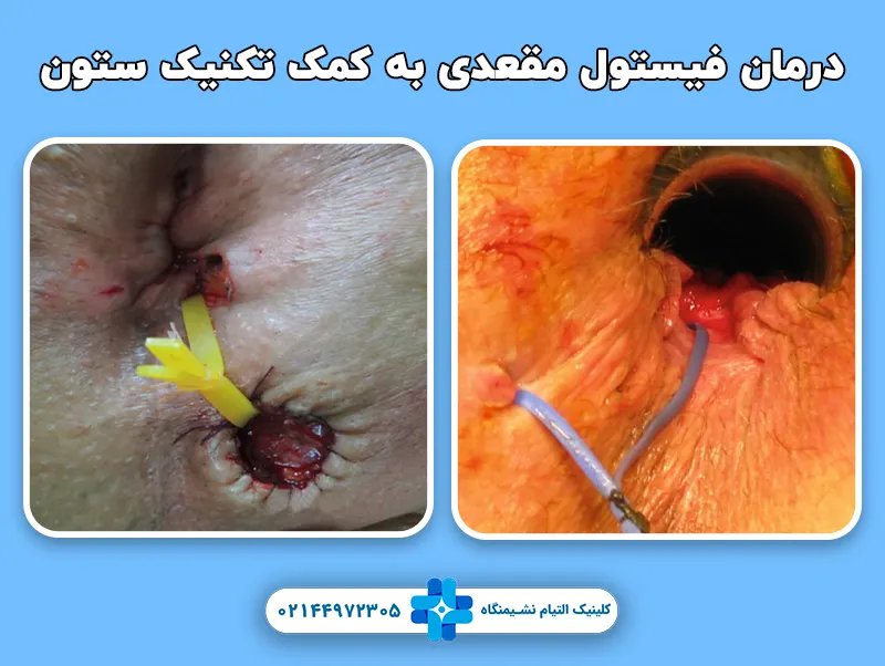درمان فیستول تکنیک ستون