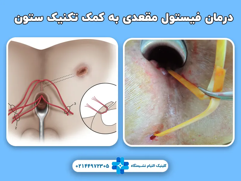 نحوه درمان فیستول به کمک تکنیک ستون