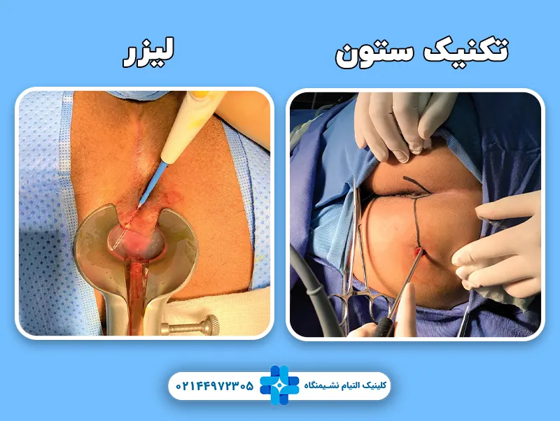 لیزر یا تکنیک ستون