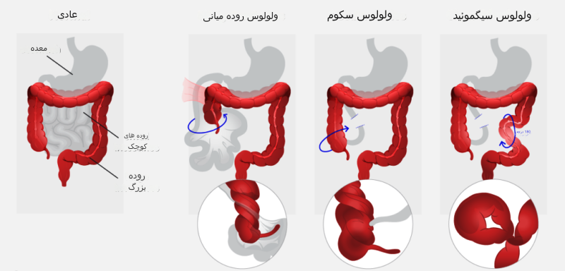 انواع انسداد روده بزرگ