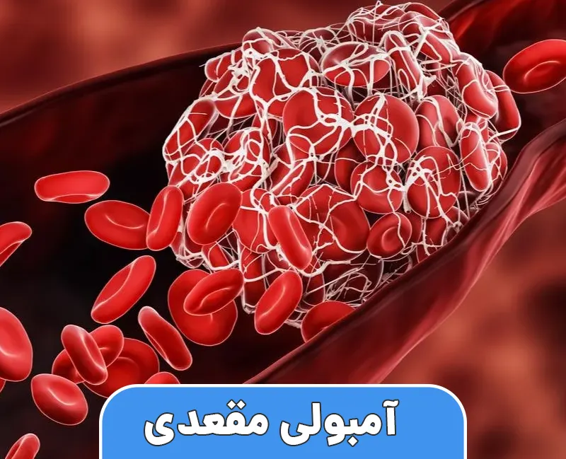 آمبولی مقعدی