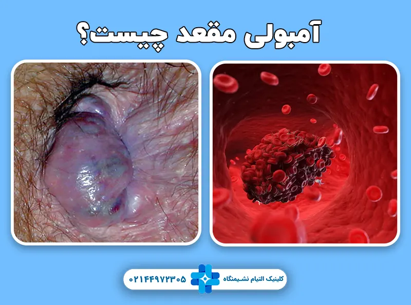 آمبولی مقعد چیست؟