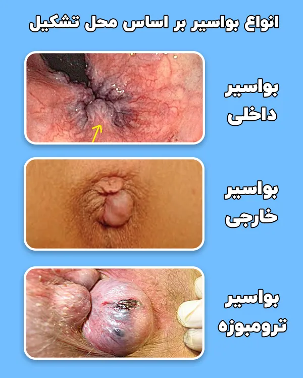 انواع هموروئید