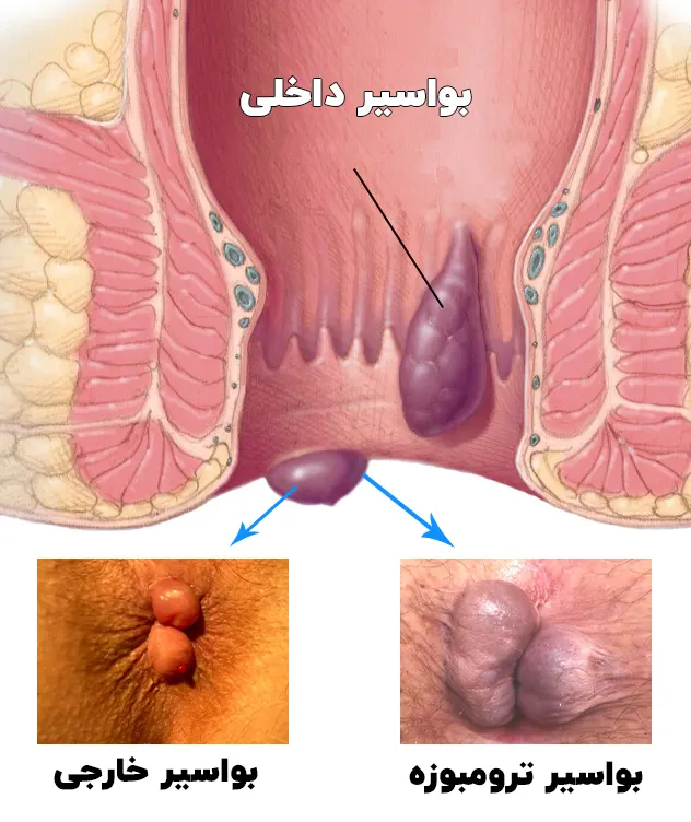 انواع بواسیر