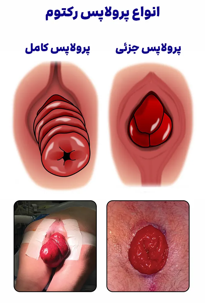انواع پرولاپس رکتوم