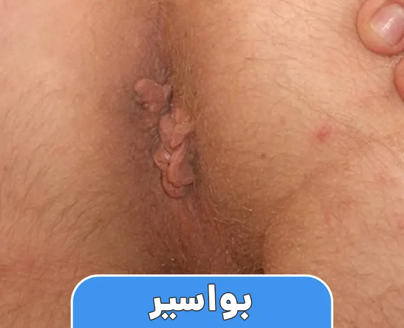 بواسیر