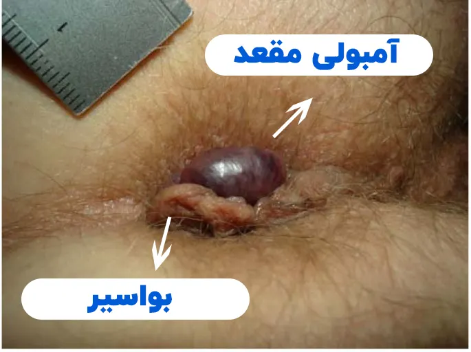 تفاوت آمبولی مقعد و بواسیر