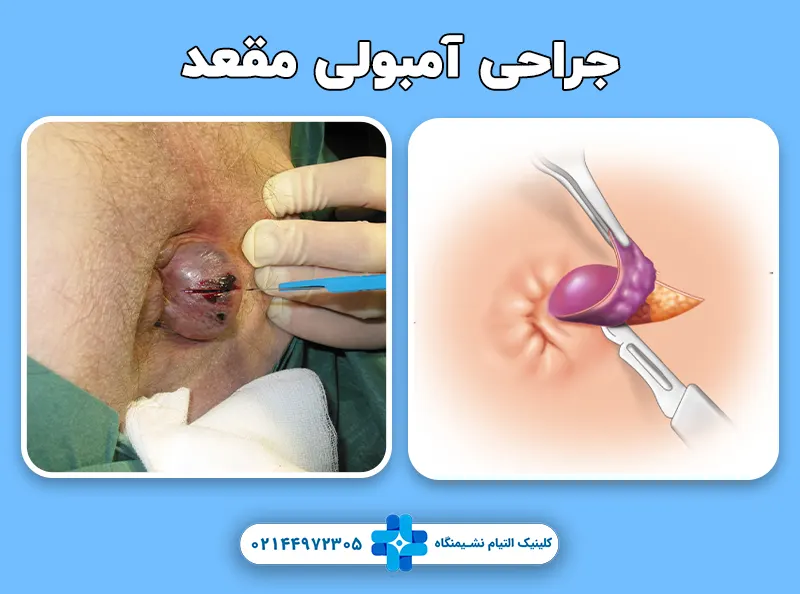جراحی آمبولی مقعد
