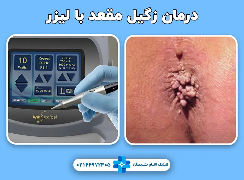 درمان زگیل مقعد با لیزر co2