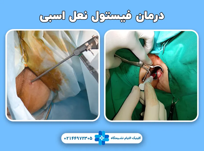 درمان فیستول نعل اسبی