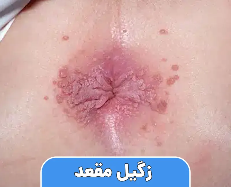زگیل مقعد