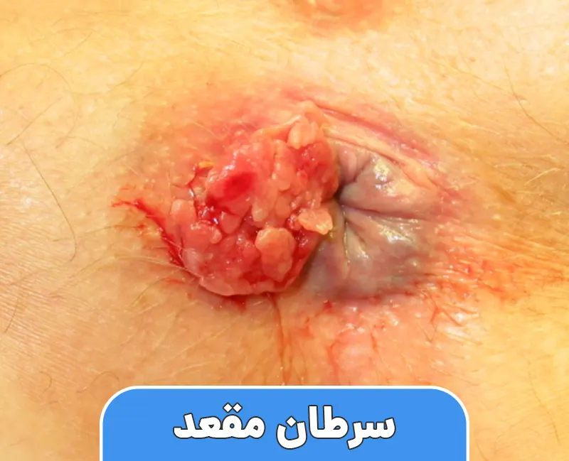 سرطان مقعد