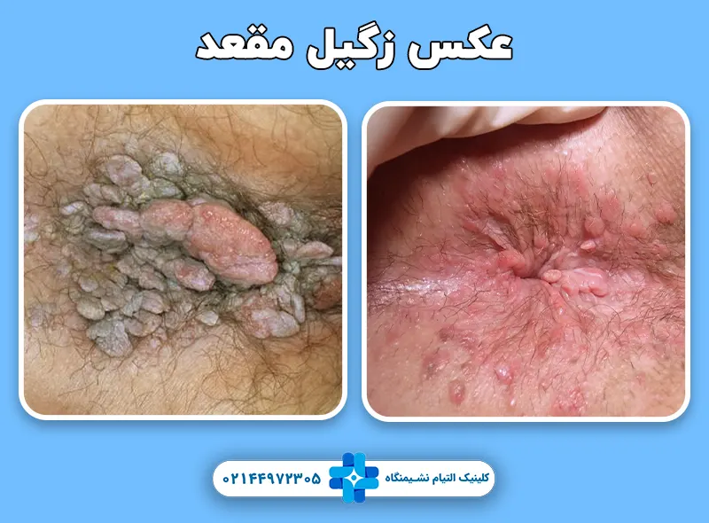 عکس زگیل مقعد