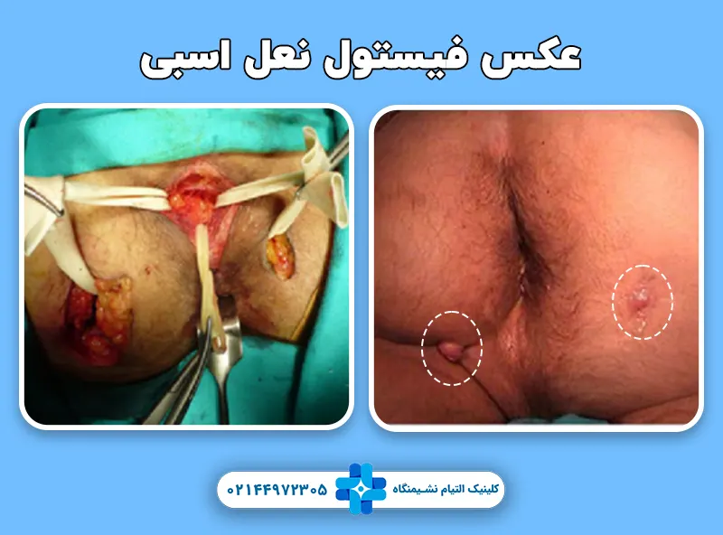 عکس فیستول نعل اسبی