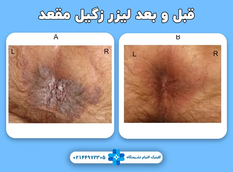 قبل و بعد لیزر زگیل