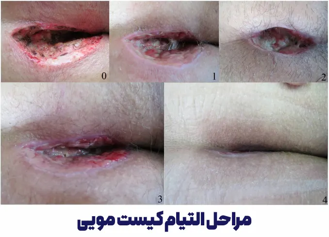 مراحل التیام کیست مویی