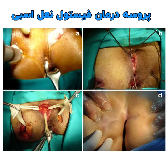 مراحل درمان فیستول نعل اسبی