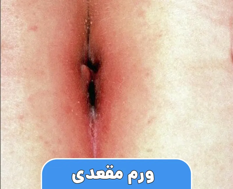 ورم مقعدی