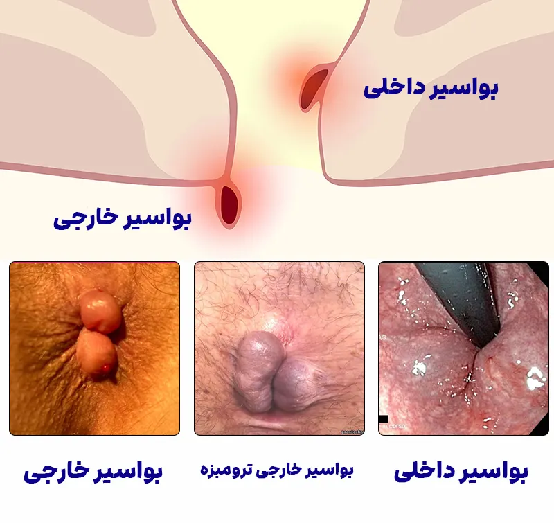 انواع همورئید