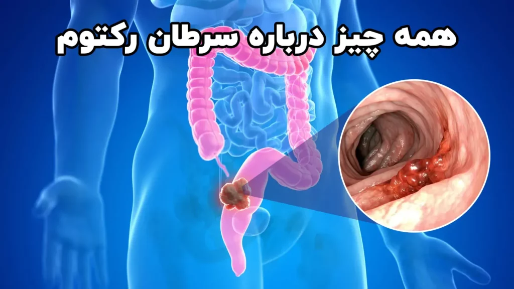 سرطان رکتوم