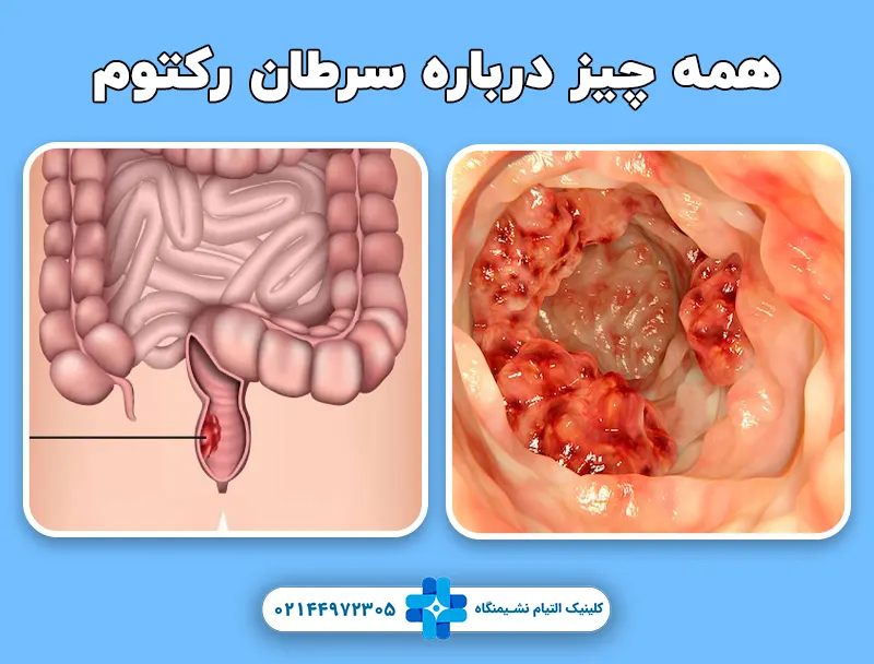سرطان رکتوم