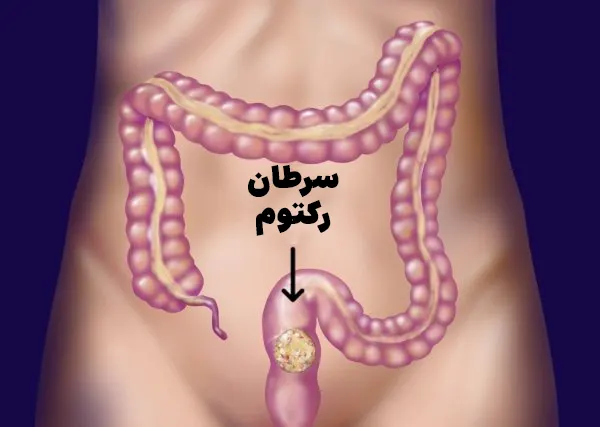 سرطان رکتوم
