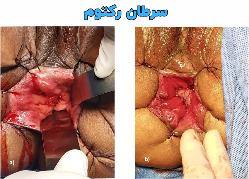 سرطان رکتوم