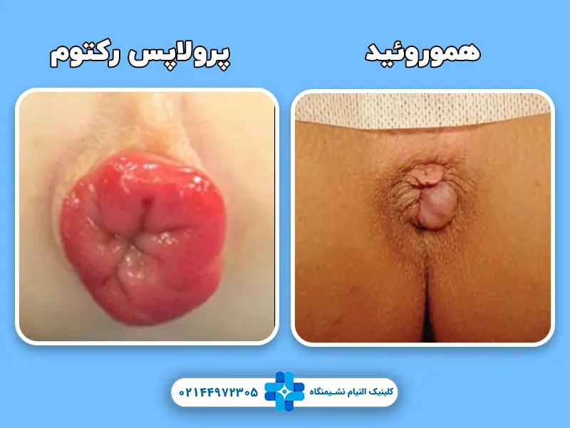 تفاوت هموروئید و پرولاپس رکتوم