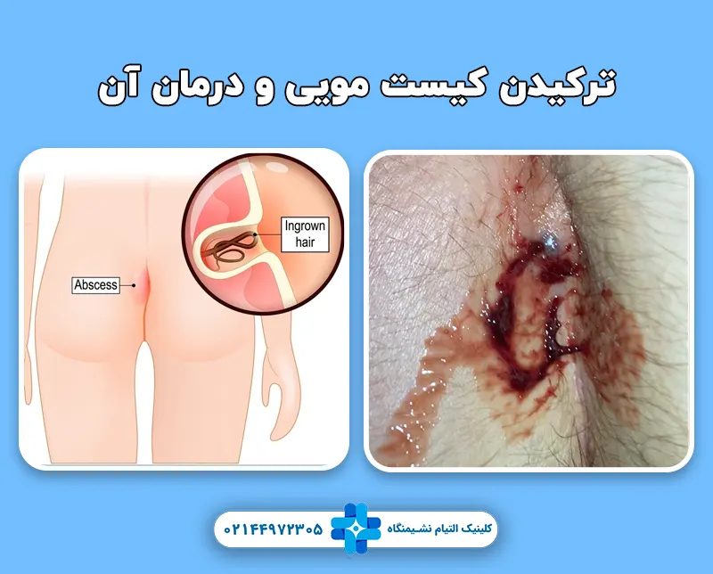 ترکیدن کیست مویی