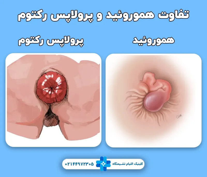 تفاوت هموروئید و پرولاپس رکتوم