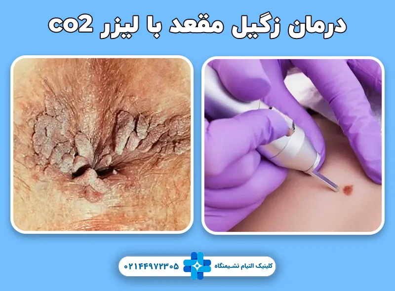 درمان زگیل مقعد با لیزر co2