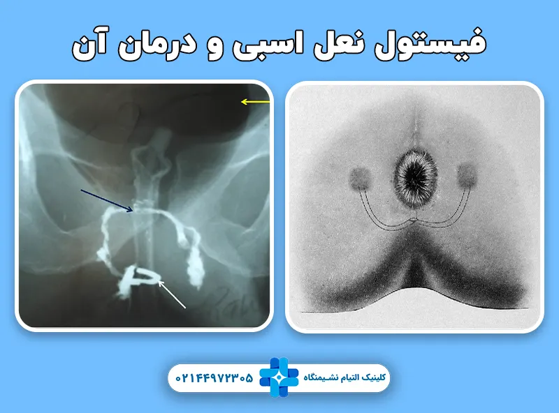 فیستول نعل اسبی