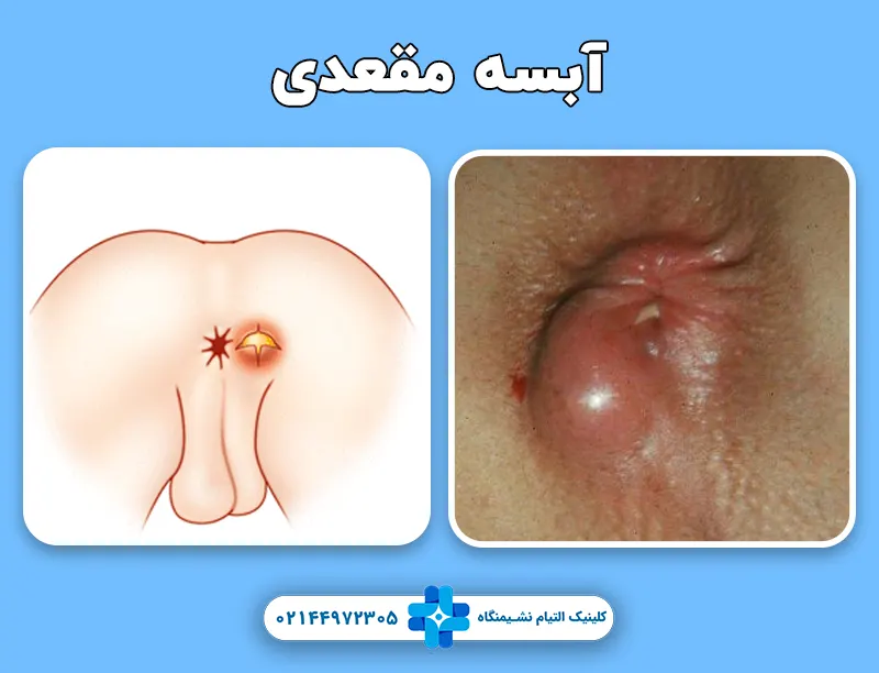 آبسه مقعدی
