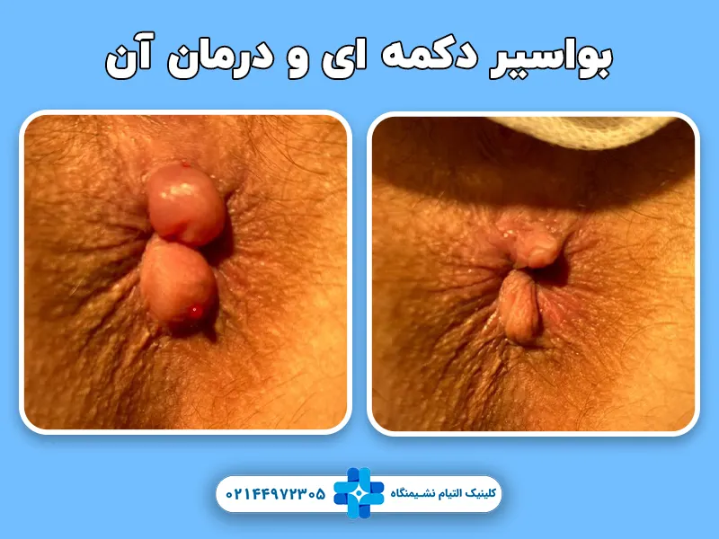بواسیر دکمه ای