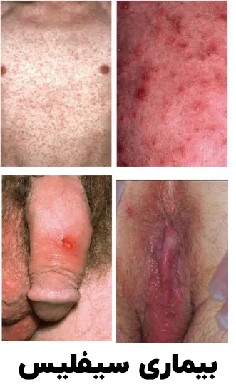 بیماری سیفلیس