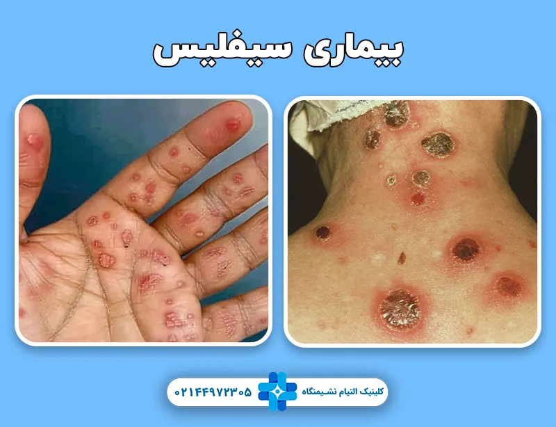 بیماری سیفلیس