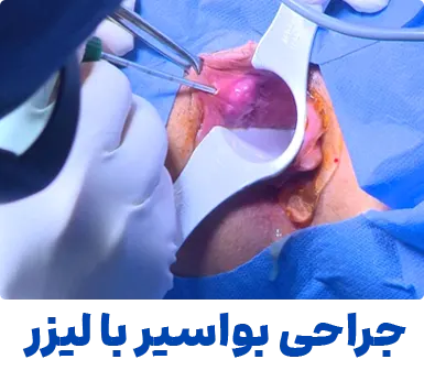 جراحی بواسیر با لیزر