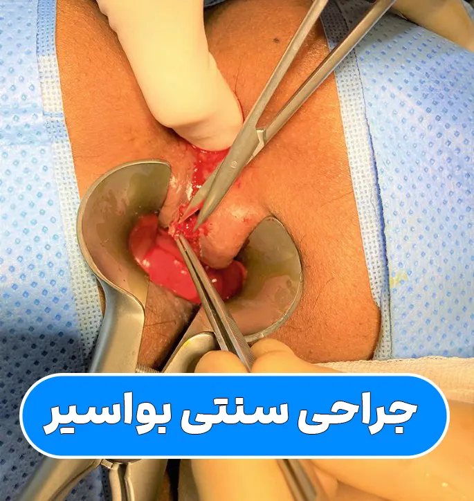 جراحی سنتی بواسیر