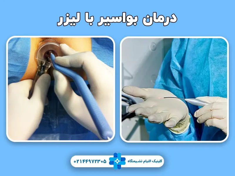 درمان بواسیر با لیزر