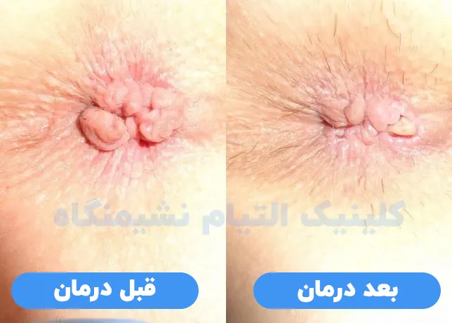 درمان بواسیر