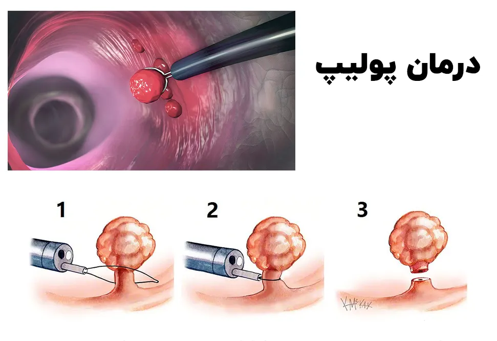 درمان پولیپ