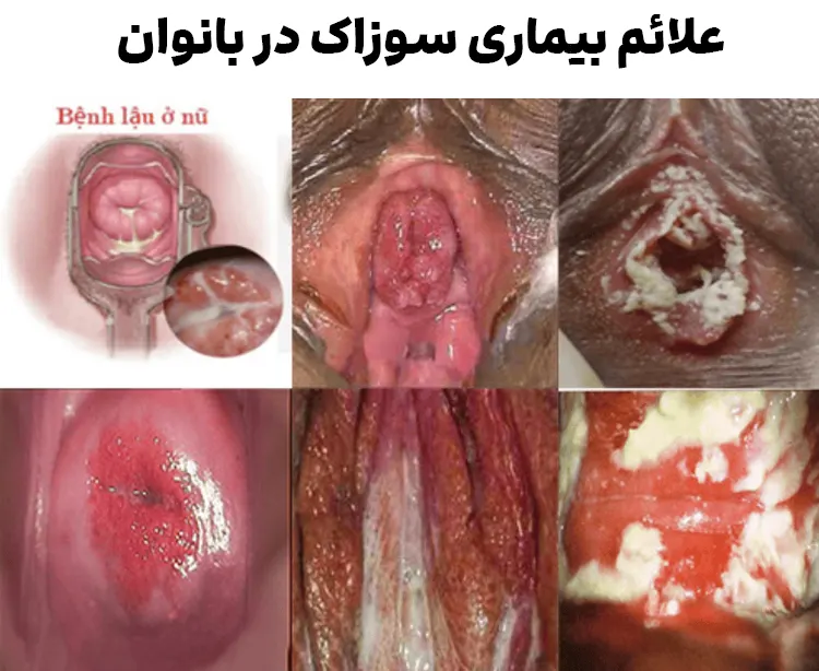 علائم سوزاک در زنان
