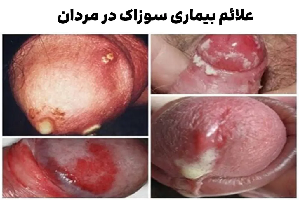 علائم سوزاک در مردان