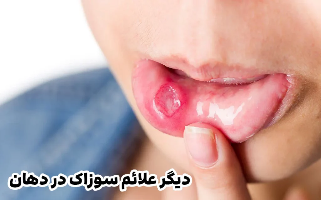 علائم سوزاک در دهان