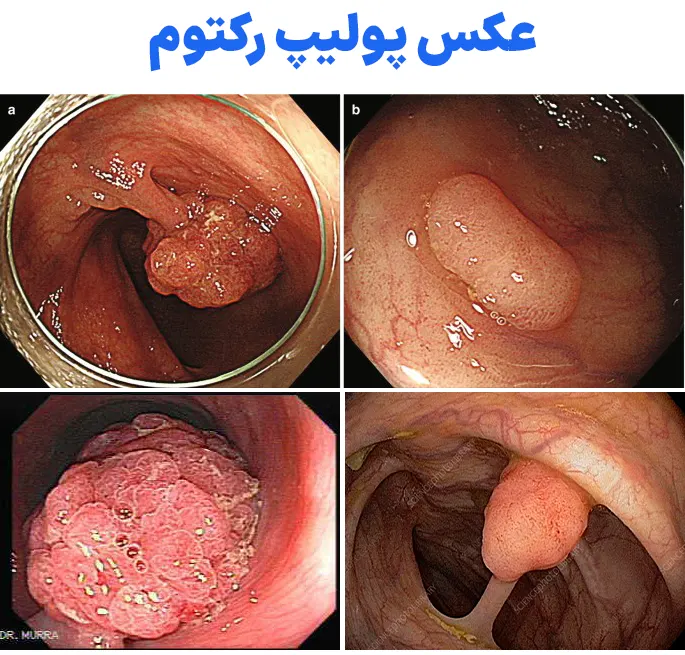 پولیپ رکتوم