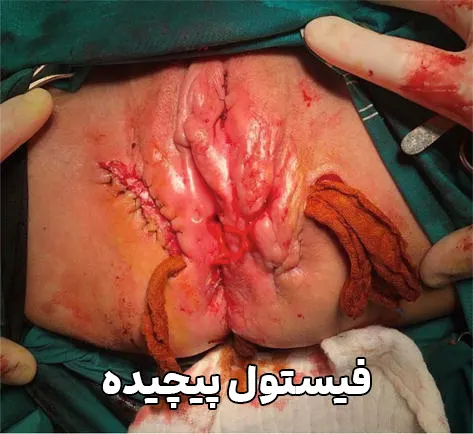 فیستول پیچیده