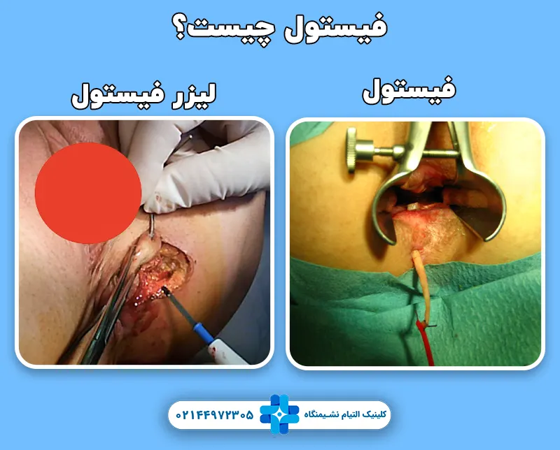 فیستول مقعدی