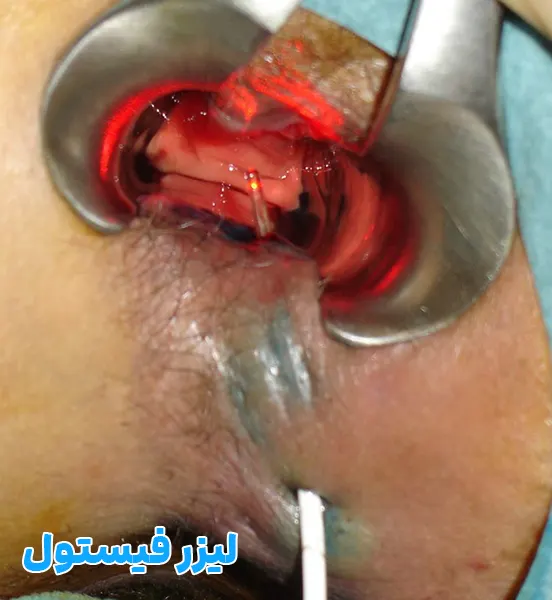 لیزر فیستول مقعد