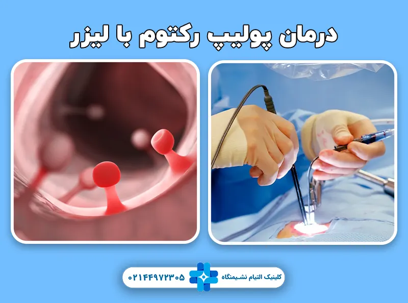 درمان پولیپ رکتوم با لیزر